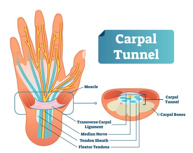 Carpal-Tunnel-Illustration